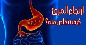 ارتجاع المرئ اسبابه وعلاجه