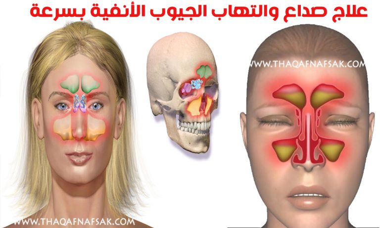 علاج احتقان الجيوب الأنفية