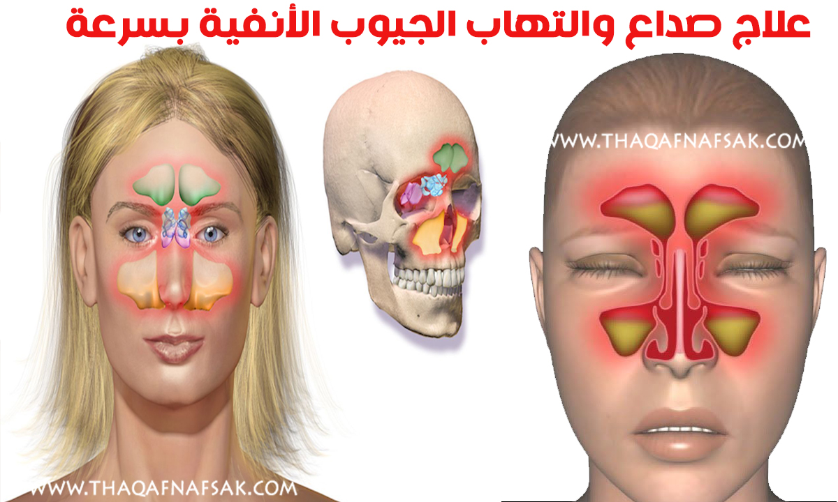 علاج احتقان الجيوب الأنفية