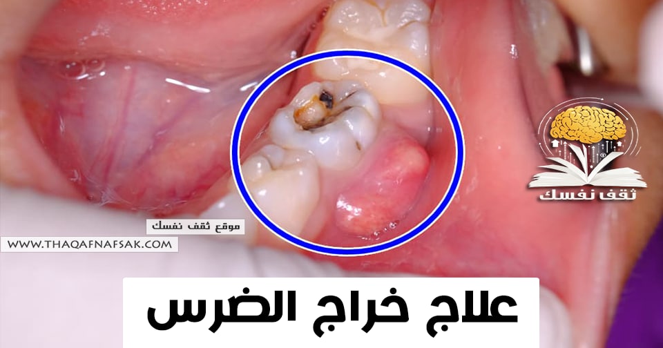 علاج خراج الضرس