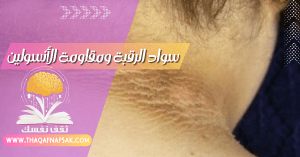 سواد الرقبة ومقاومة الأنسولين